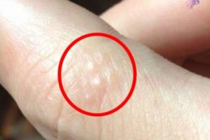 รู้ไว้ก่อนสาย !! ตุ่มน้ำใสๆ บนนิ้วมือ ฝ่ามือ ฝ่าเท้า เตือนว่าเป็นโรคร้ายแบบนี้ เช็คด่วนเลย !